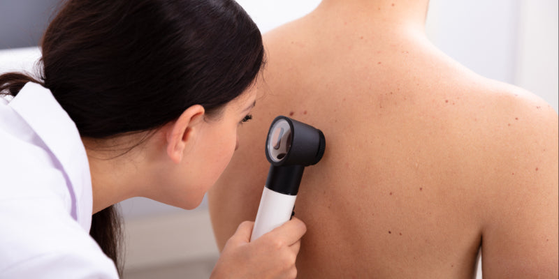 Dermoscopy for melanoma