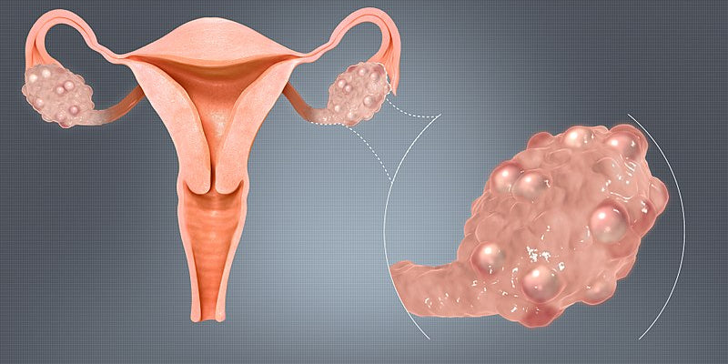 Polycystic Ovarian Syndrome