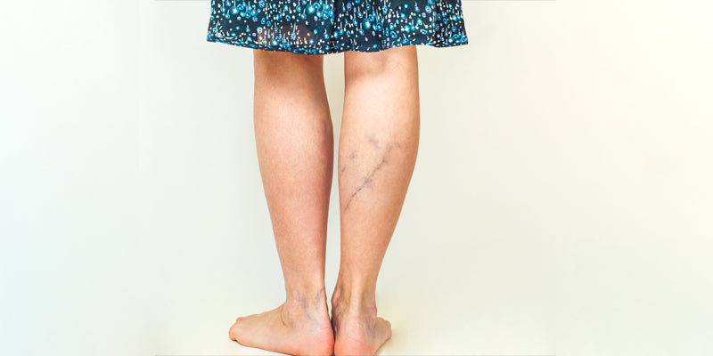 Varicose veins, venous leg ulcers and DVT